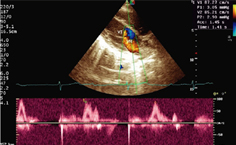 High-grade idiopathic atrioventricular block in childhood: Case report and literature review
