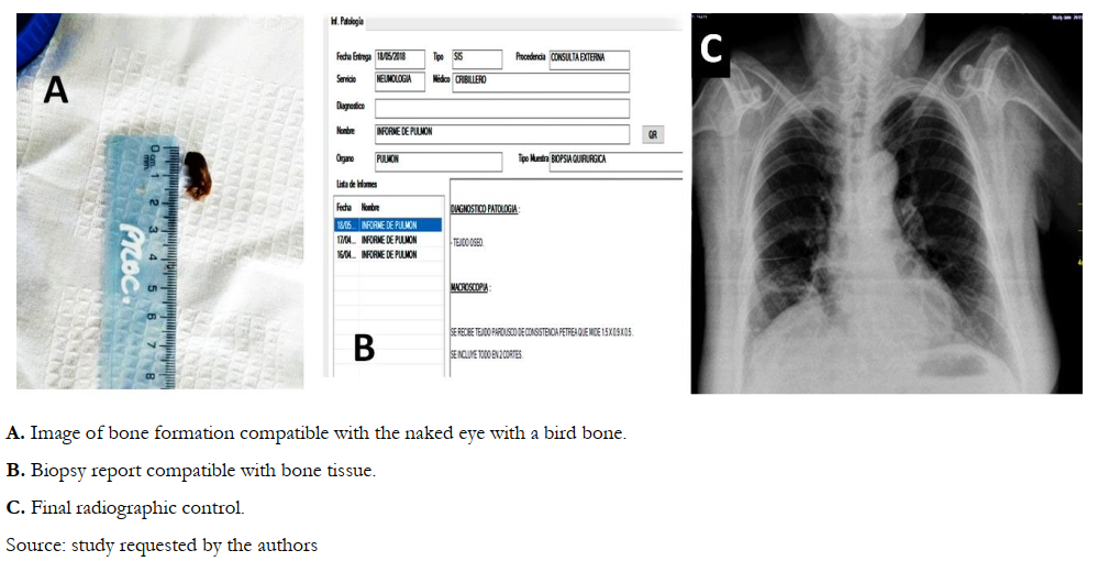 Case report of recurring pneumonia due to unusual foreign body