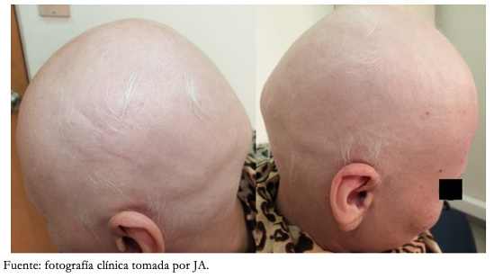 <b> Figura 1. </b> Paciente previo al inicio de tratamiento con simvastatina y ezetimibe.