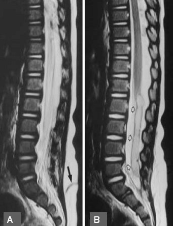 Quiste Pilonidal Medwave