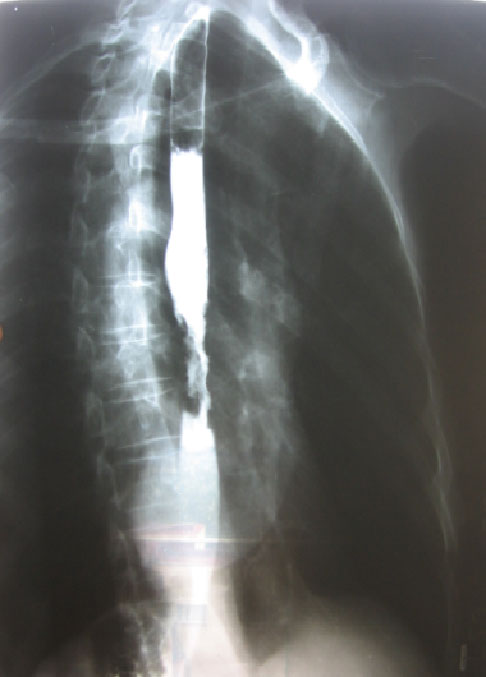 <b>Figura 1.</b>  Radiografa del esfago contrastada. Zona de estenosis irregular con defecto de lleno.