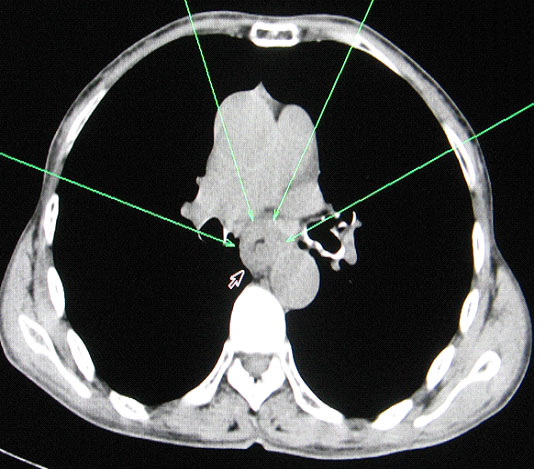 <b>Figura 2.</b> TAC multicorte Trax. Sealado la estenosis tumoral esofgica.