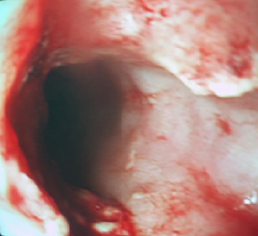 <b>Figura 3.</b> Endoscopa. Lesiones esofgicas del VPH y del carcinoma (abajo e izquierda y al fondo estenosando).